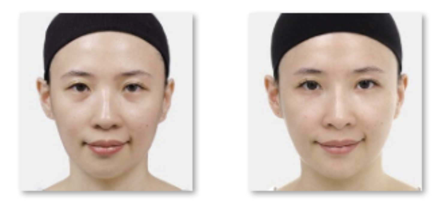 NASHA純粹玻尿酸淚溝