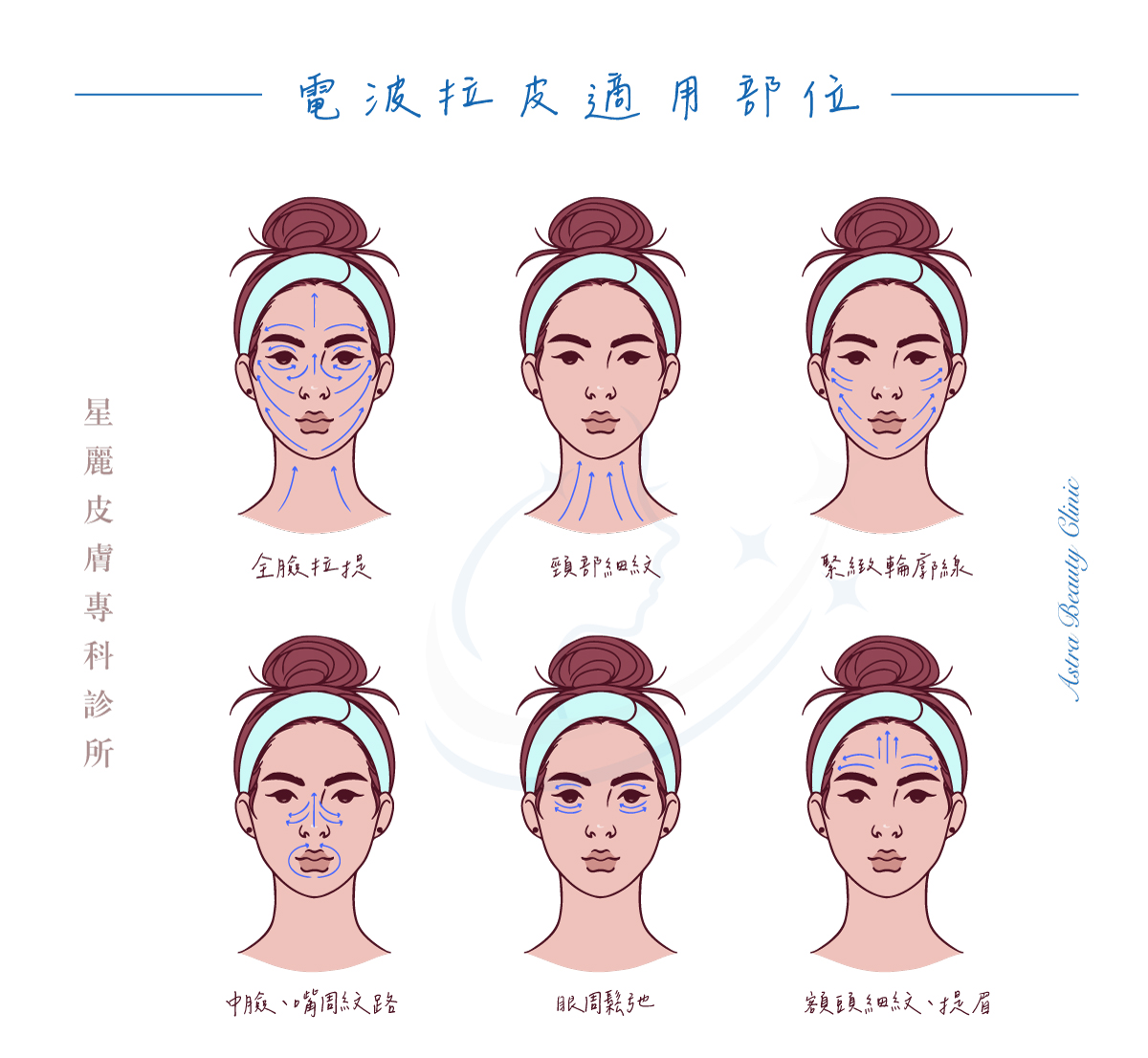 鳳凰電波拉皮