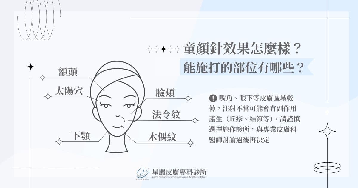 童顏針效果怎麼樣？ 4D 童顏針能施打的部位有哪些？
