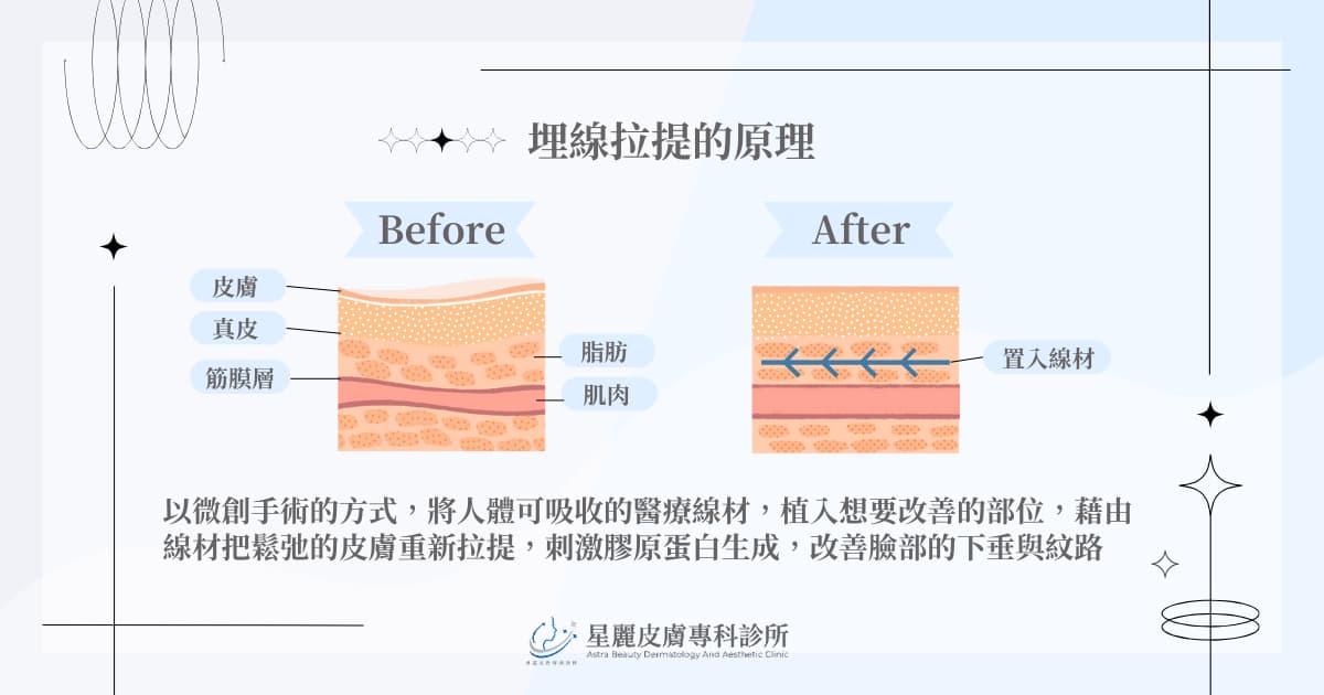 埋線拉提的原理、效果