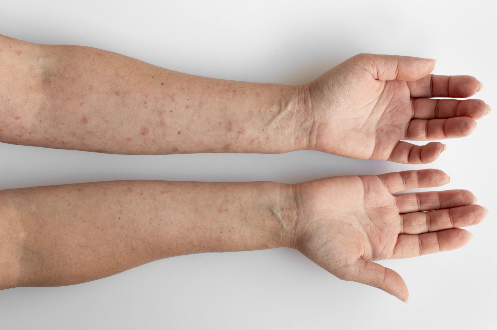 氯過敏性皮膚炎 skinallergies