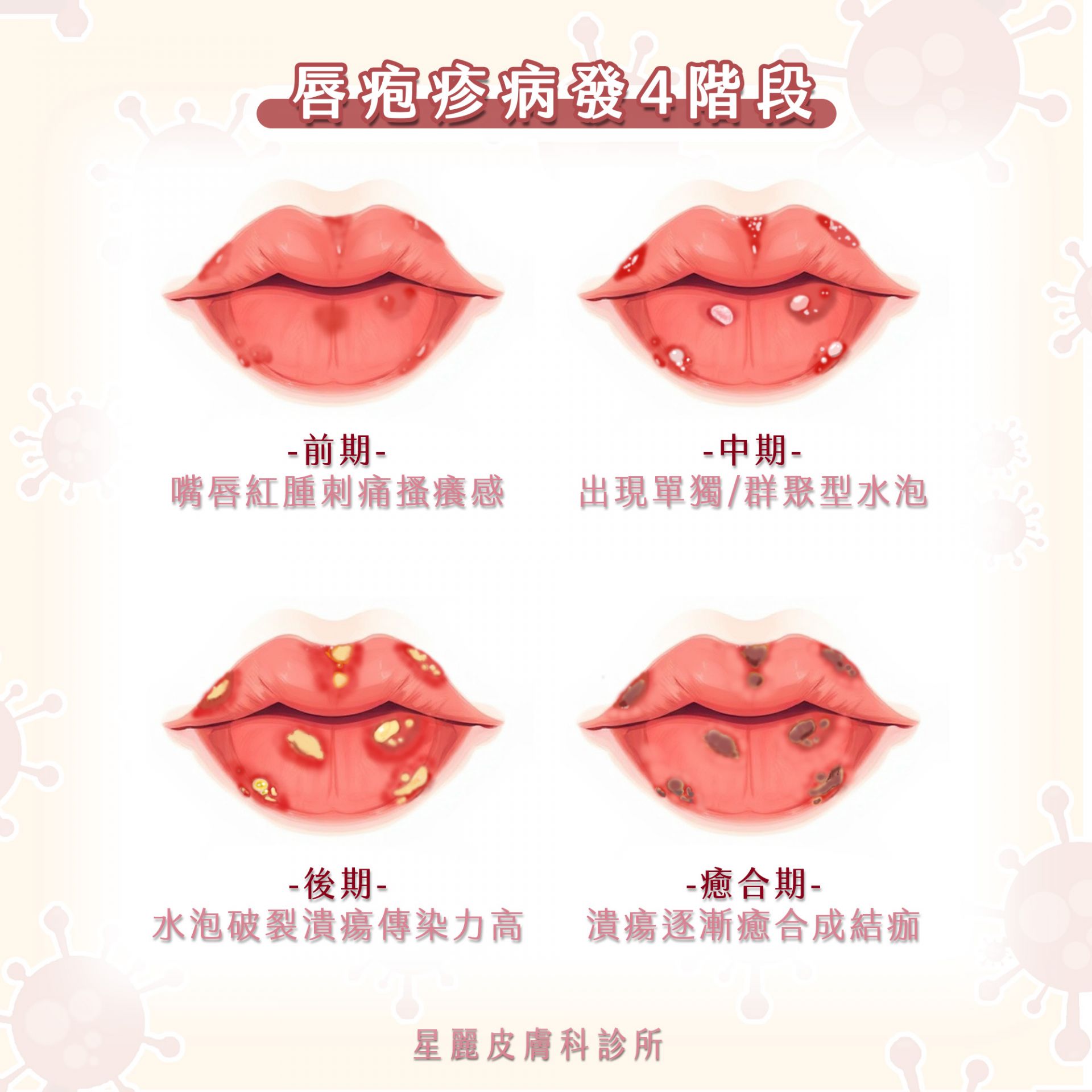 唇疱疹症狀 herpes simplex