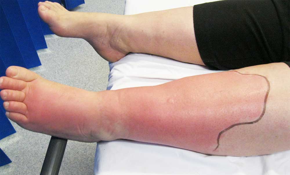 蜂窩性組織炎 cellulitis