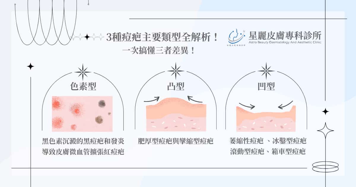 3 種痘疤主要類型全解析!一次搞懂三者差異!