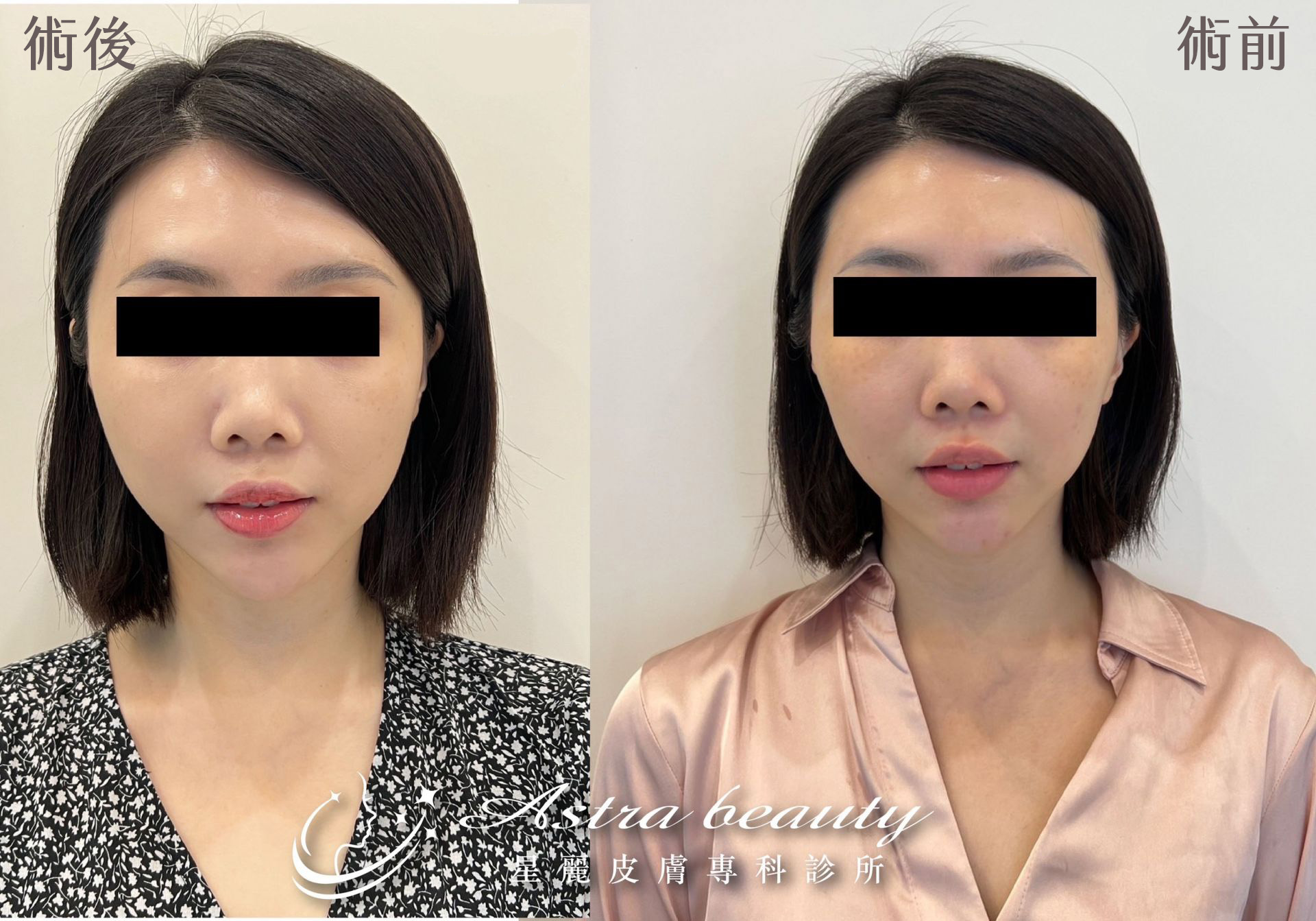 埋線拉提美特拉線雕案例