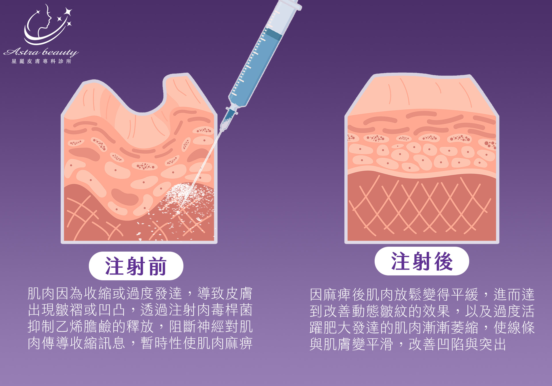 保妥適 BOTOX 經典肉毒