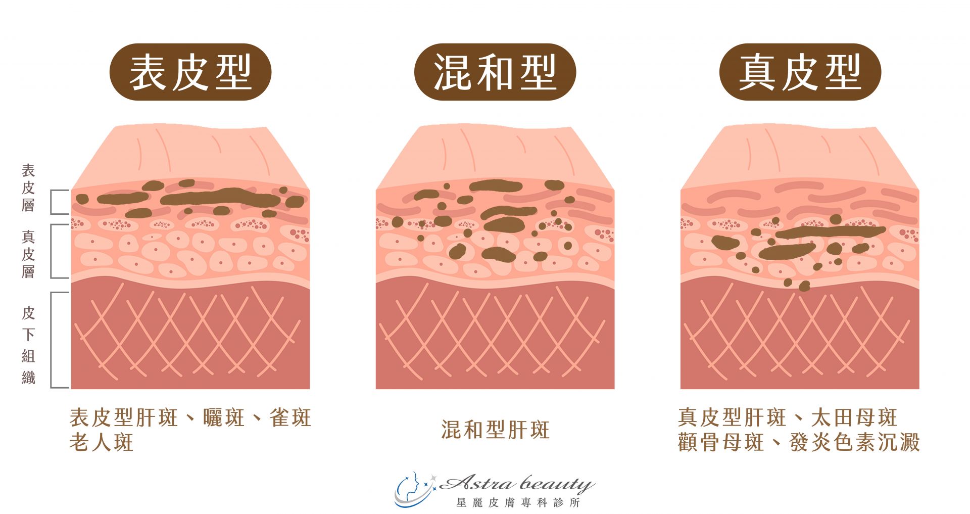 肝斑類型