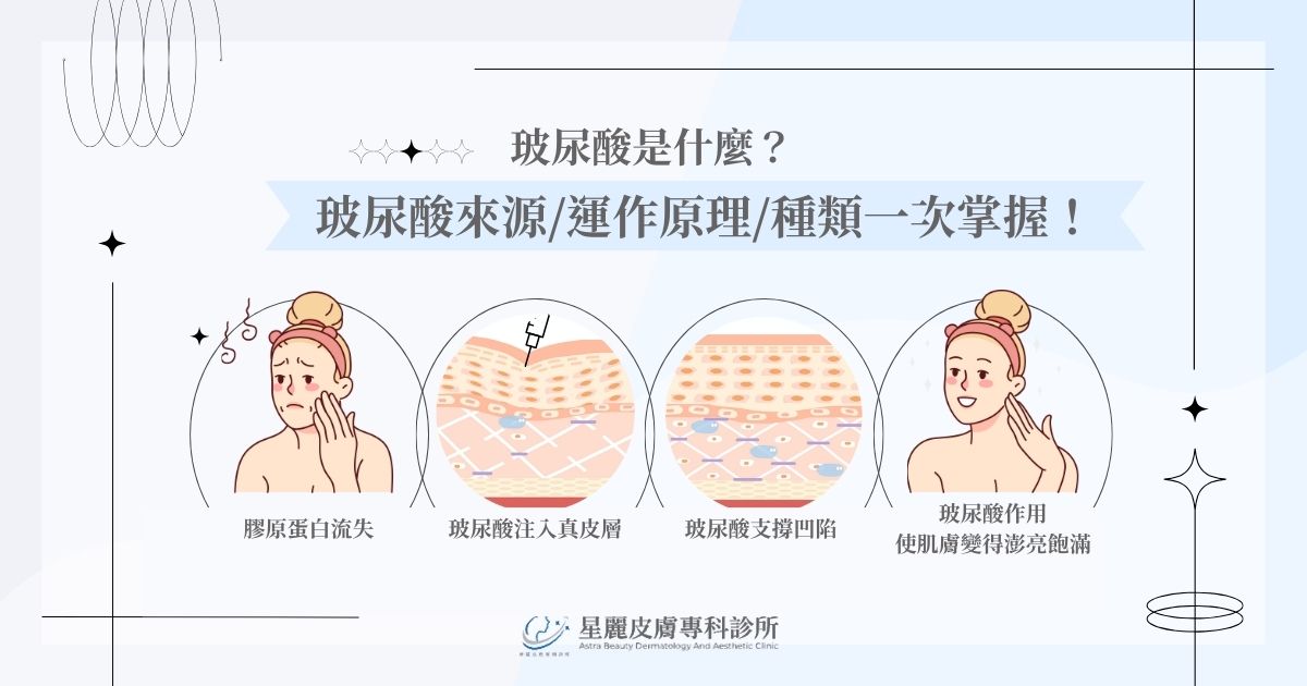 玻尿酸是什麼？玻尿酸來源/運作原理/種類一次掌握！