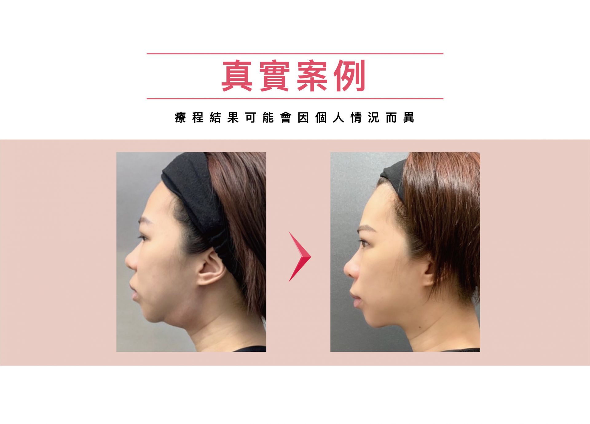 Ronkyla容脂針