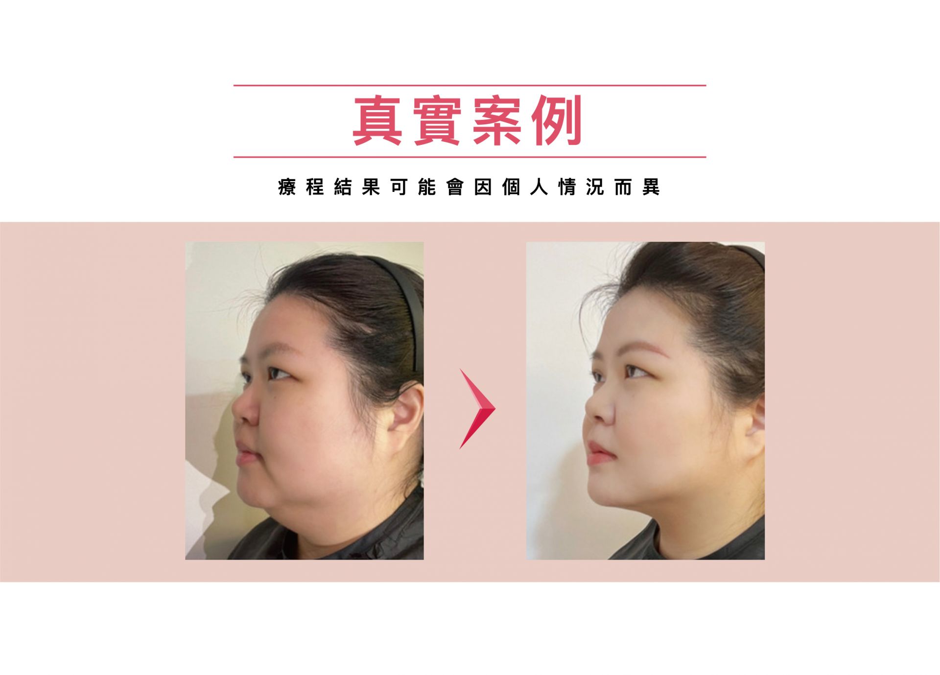Ronkyla容脂針