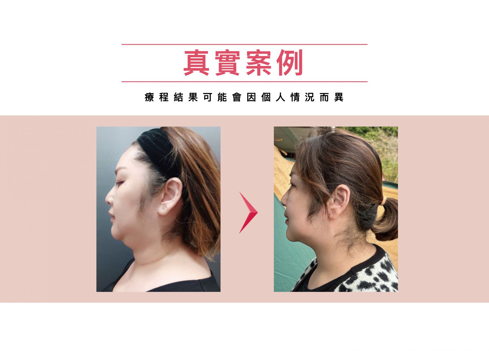 Ronkyla容脂針
