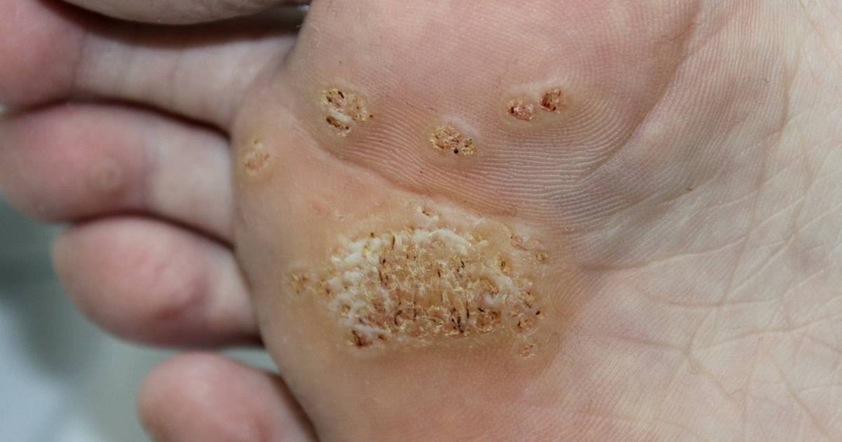 足底疣(Plantar Warts)雞眼