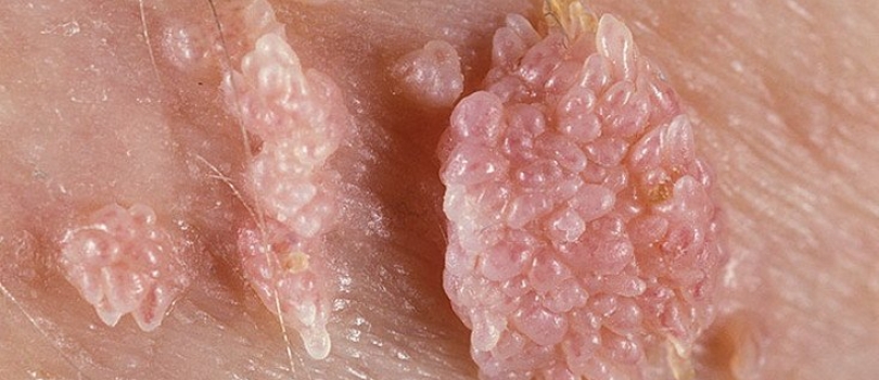 尖銳濕疣(Genital Warts)菜花 HPV