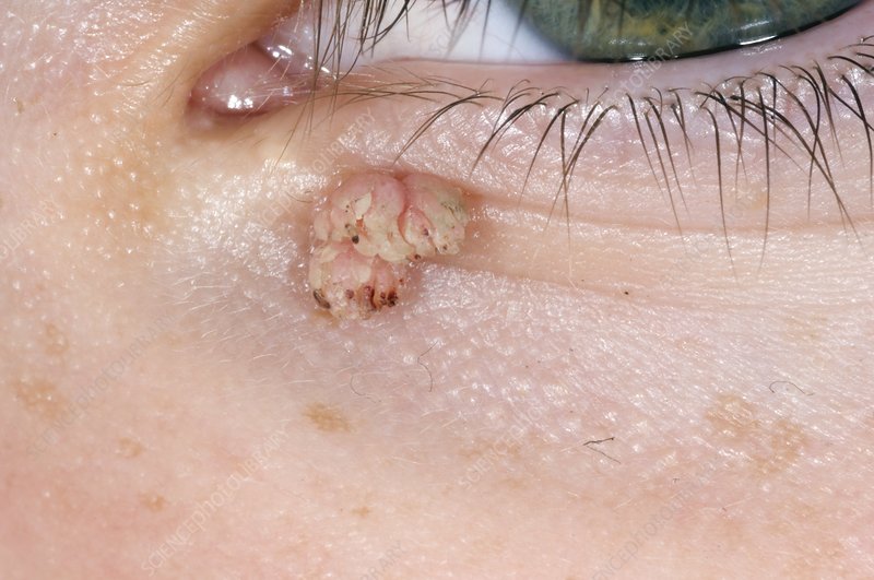 絲狀疣(Filiform Warts)