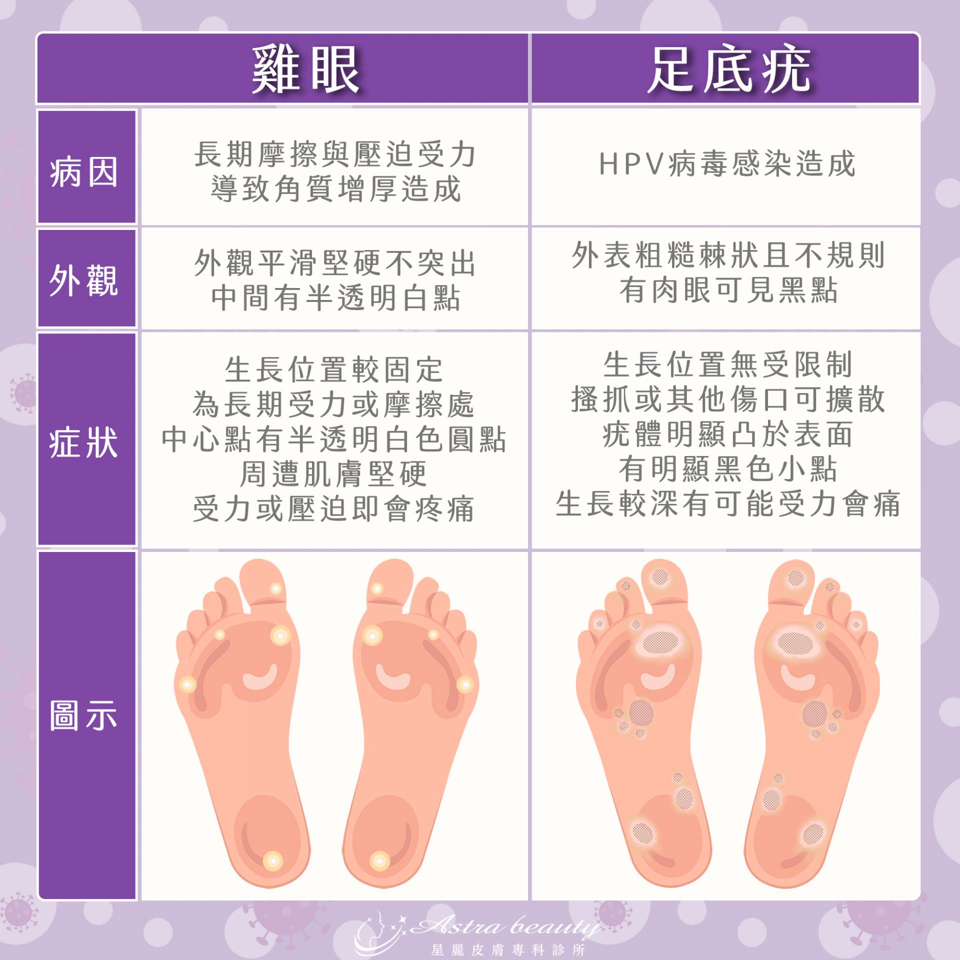 病毒疣與雞眼的差異