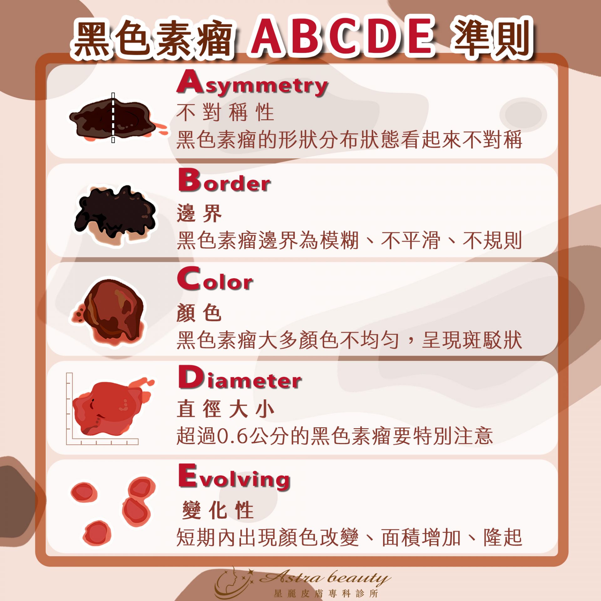 黑色素瘤(Malignant Melanoma)ABCDE法則
