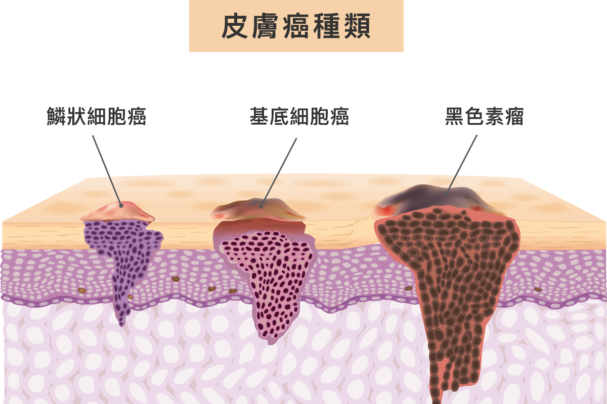 常見皮膚癌種類-黑色素瘤(Malignant Melanoma)