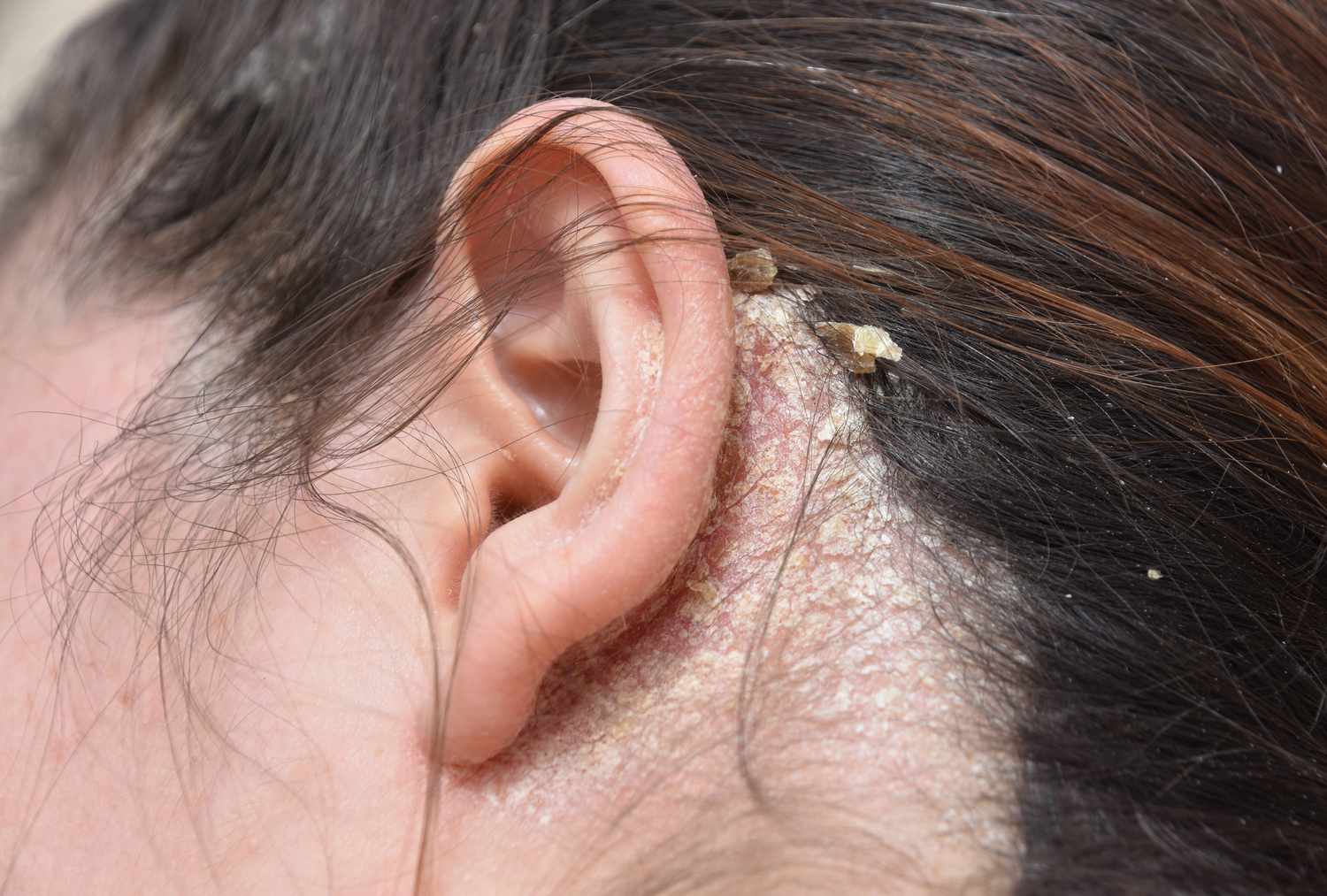 脂漏性皮膚炎(Seborrheic Dermatitis)