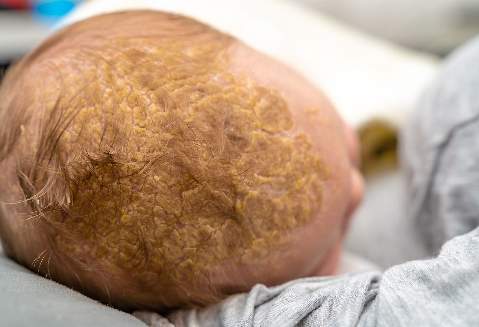 嬰兒 搖籃帽 脂漏性皮膚炎(Seborrheic Dermatitis)