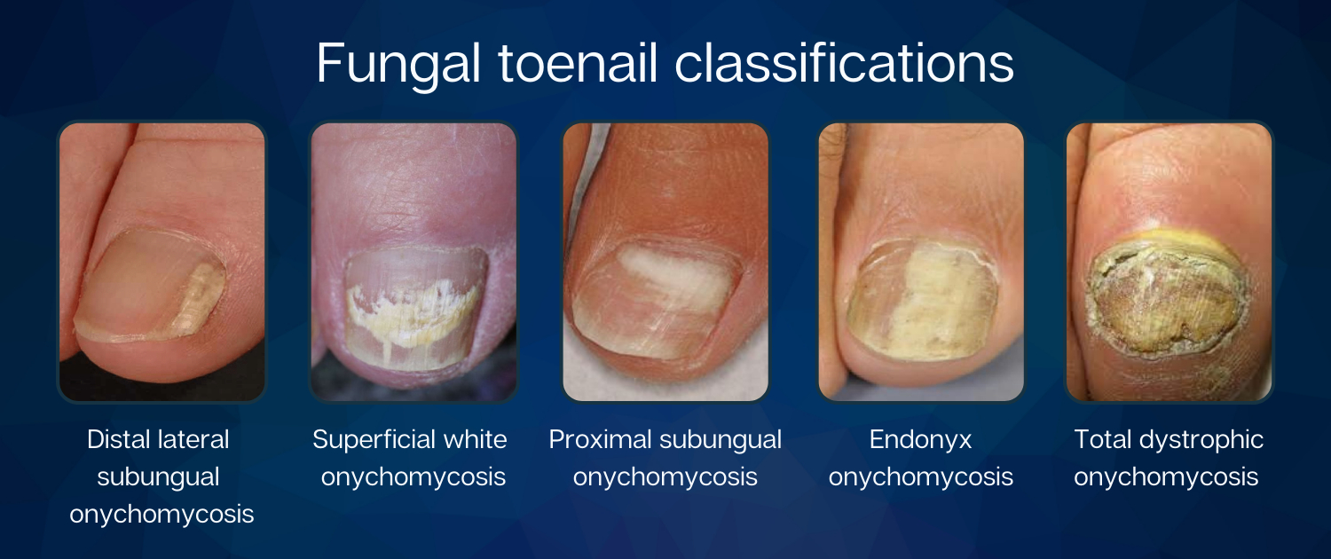 灰指甲 甲癬 (Onychomycosis )