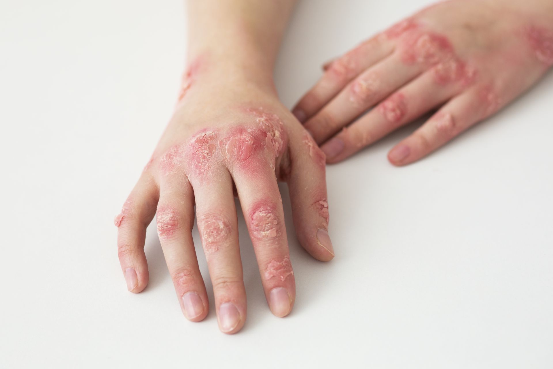 手部濕疹（Hand Eczema、Hand Dermatitis）富貴手