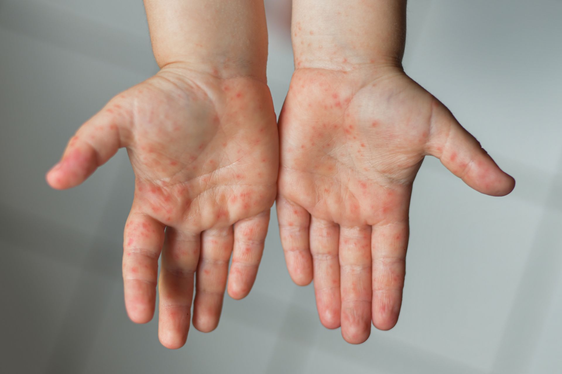 手部濕疹(Hand Eczema、Hand Dermatitis)富貴手、汗皰疹