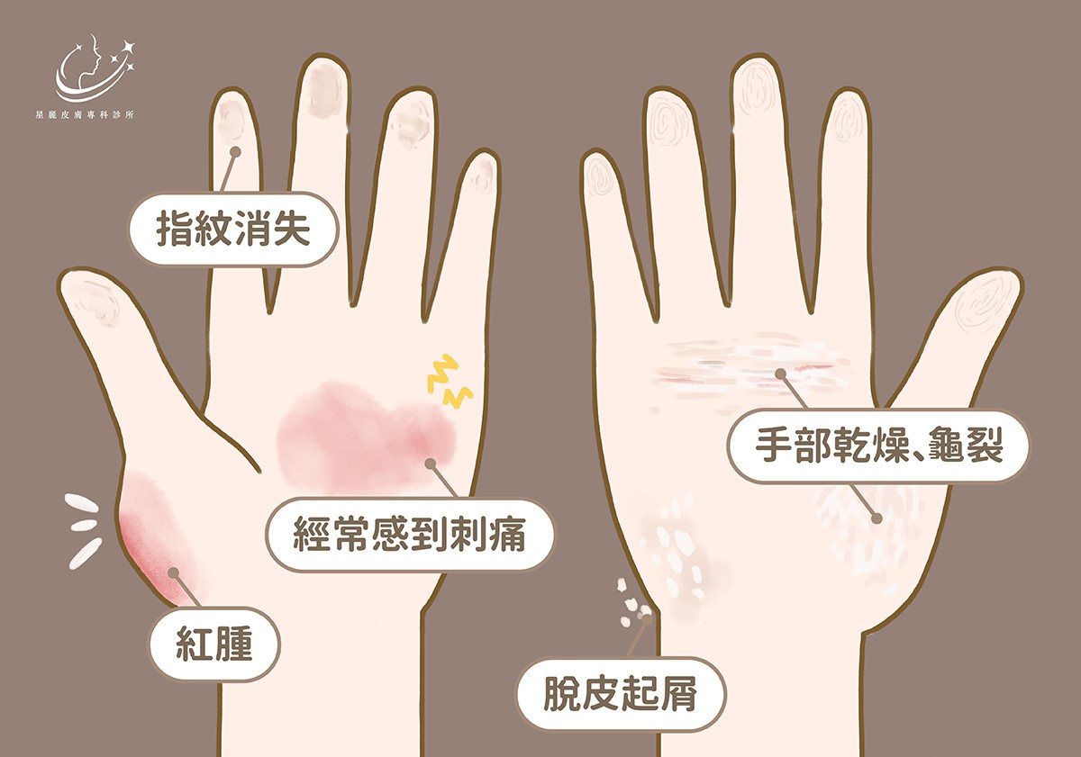 手部濕疹(Hand Eczema、Hand Dermatitis)富貴手常見症狀