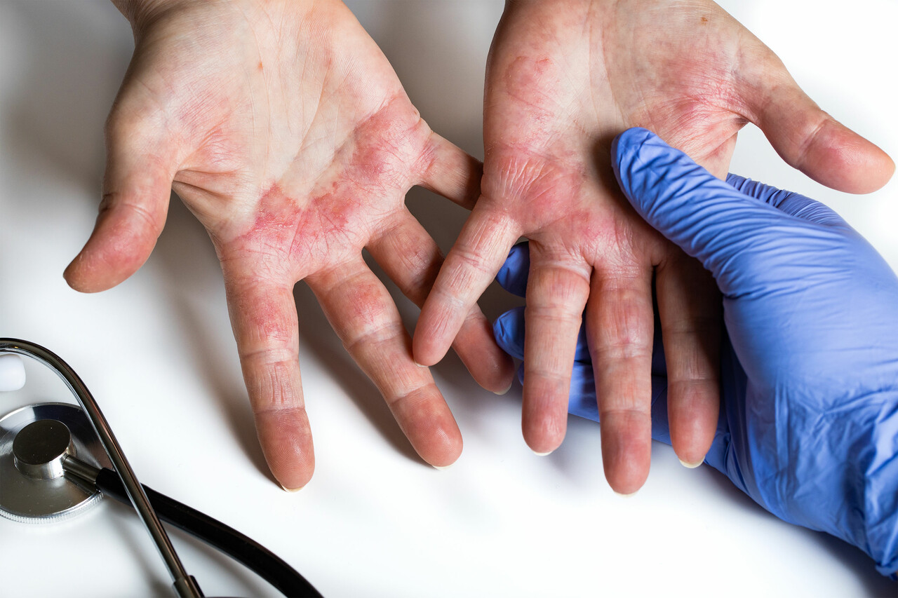 手部濕疹(Hand Eczema、Hand Dermatitis)富貴手