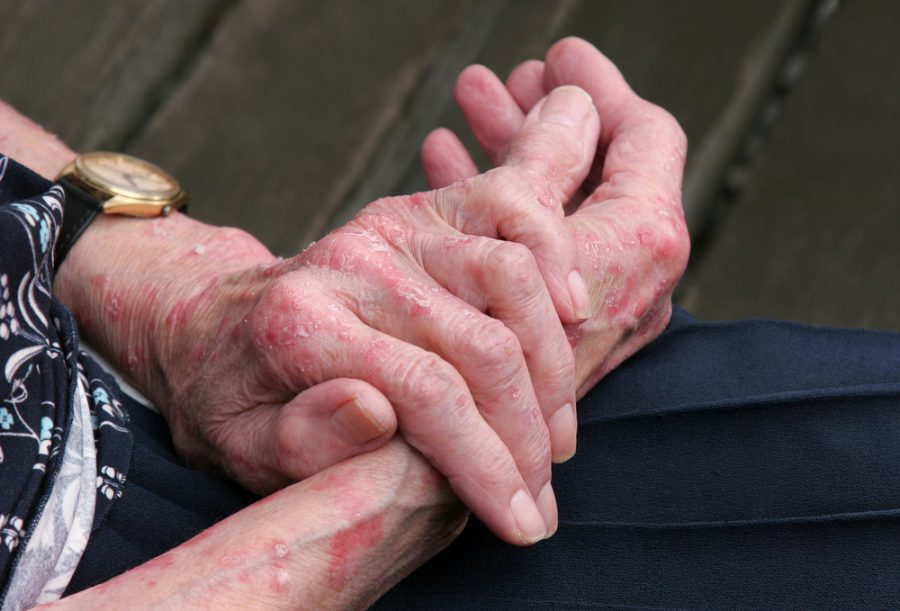 手部濕疹(Hand Eczema、Hand Dermatitis)富貴手