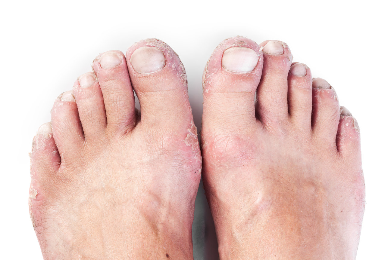 香港腳（足癬，Tinea Pedis）