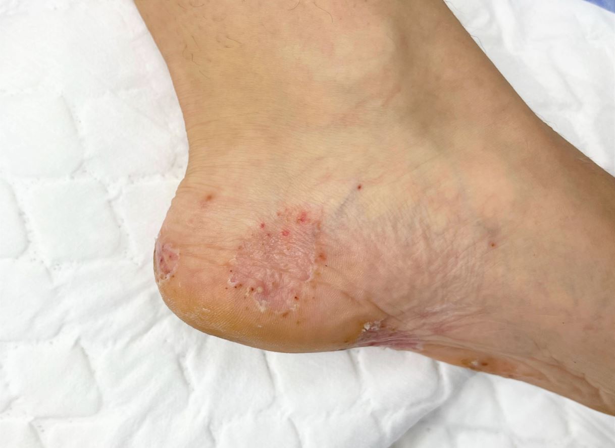 香港腳(足癬,Tinea Pedis)水泡型