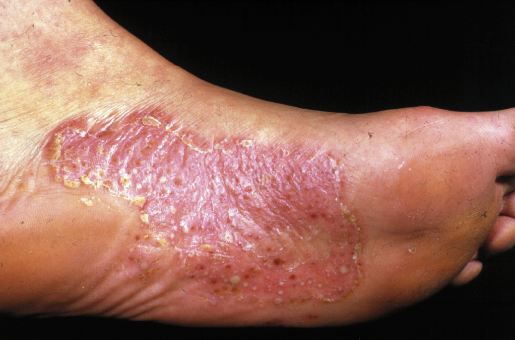 香港腳(足癬,Tinea Pedis)潰瘍型