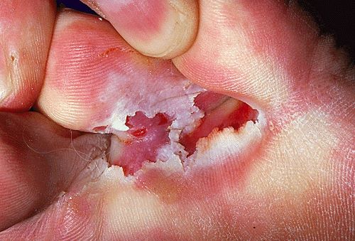 香港腳(足癬,Tinea Pedis)趾間型-濕