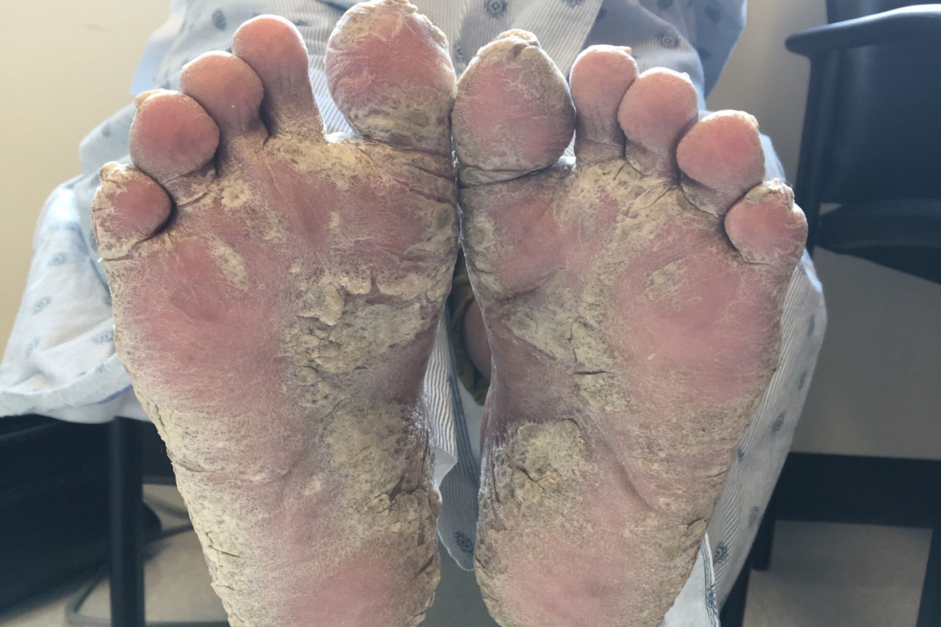 香港腳(足癬,Tinea Pedis)角化型