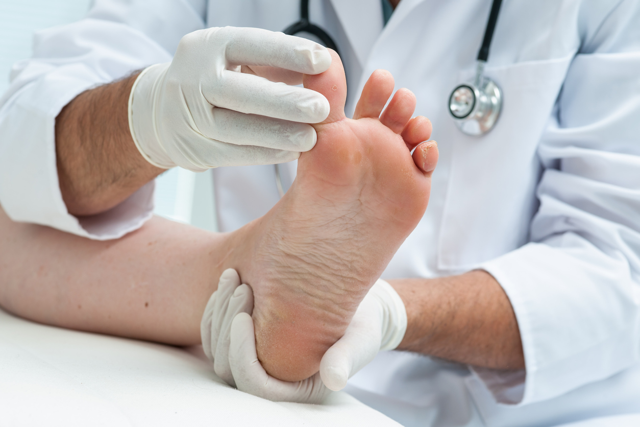 香港腳(足癬,Tinea Pedis)診斷治療