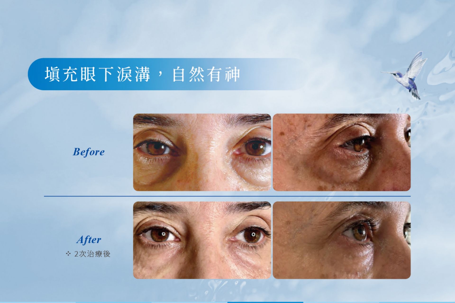 喬雅露JuveLook術後臨床治療案例