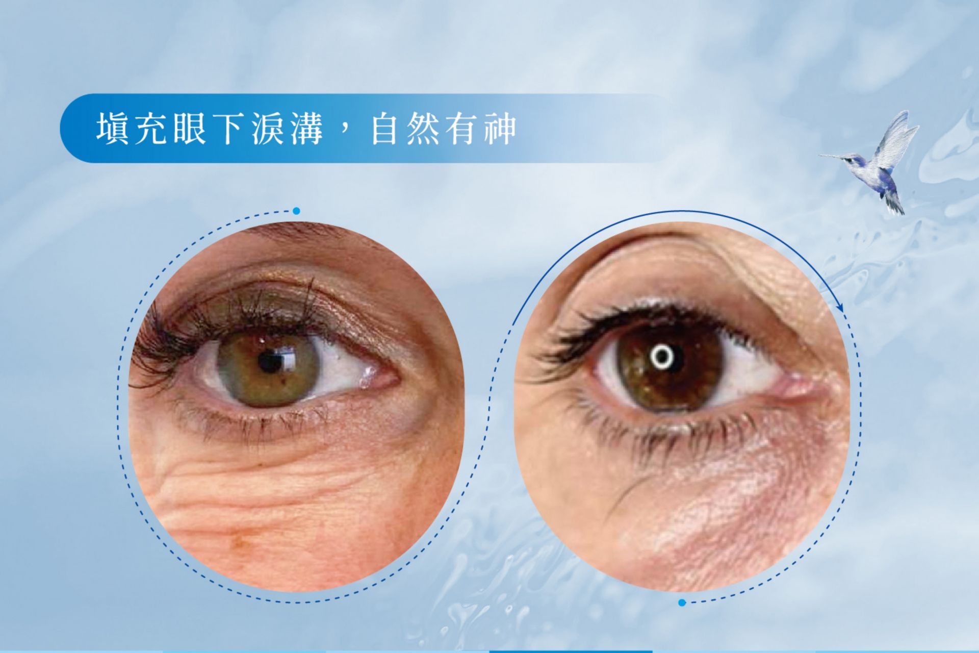喬雅露JuveLook術後臨床治療案例