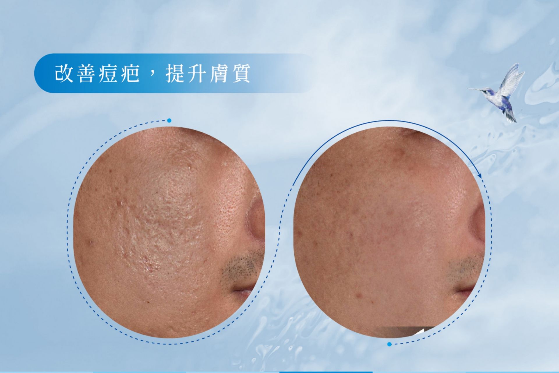 喬雅露JuveLook術後臨床治療案例