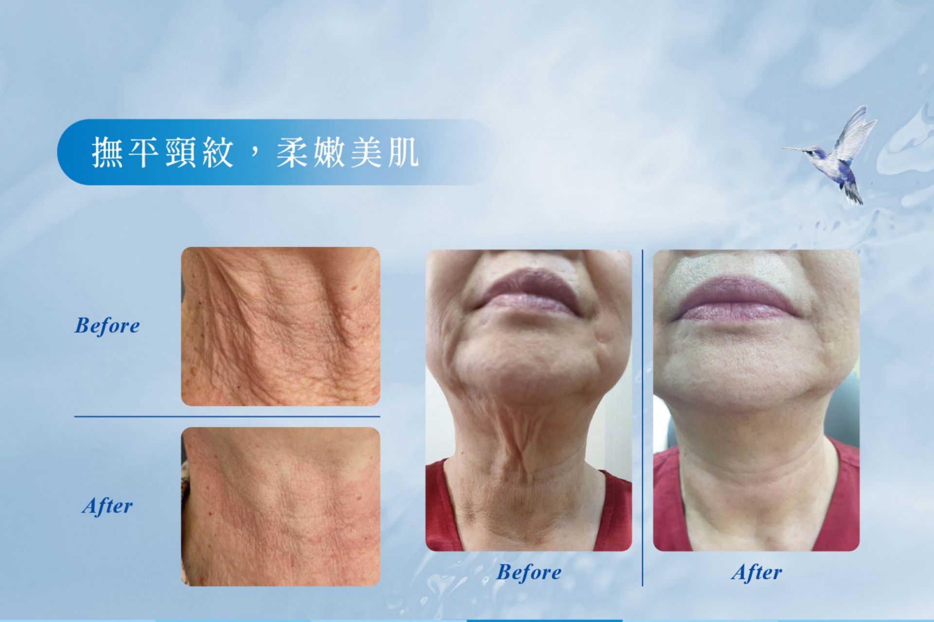 喬雅露JuveLook術後臨床治療案例