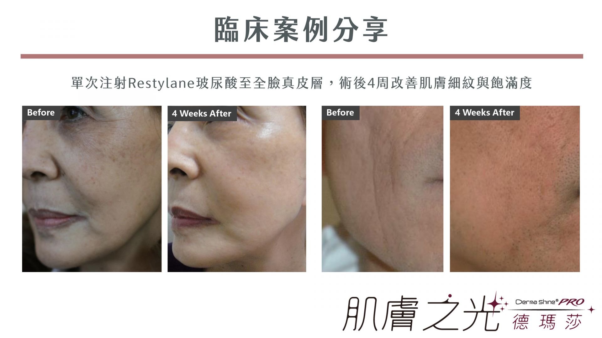 德瑪莎水光槍DermaShine術後臨床治療案例