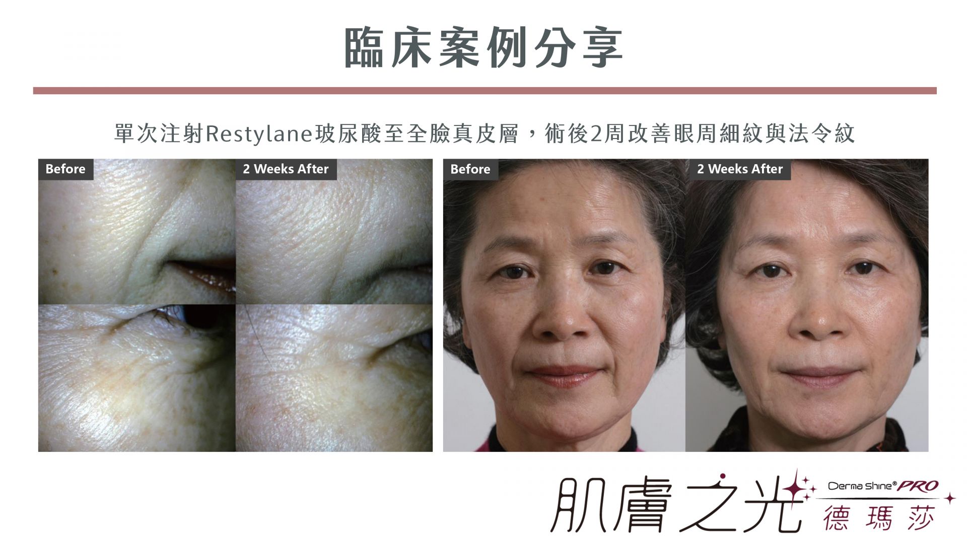 德瑪莎水光槍DermaShine術後臨床治療案例