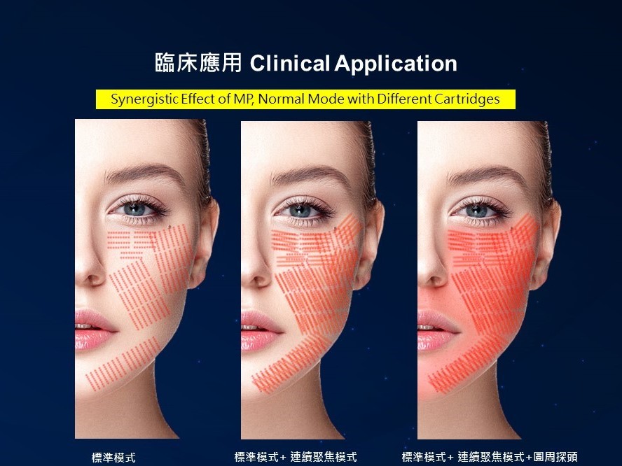 海芙音波媚必提臉部適用