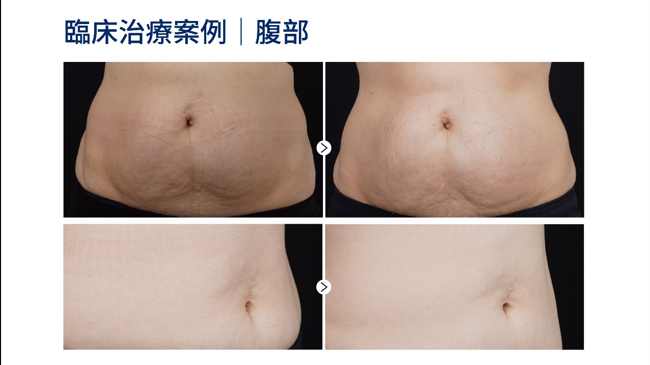 海芙音波媚必提肚子腹部