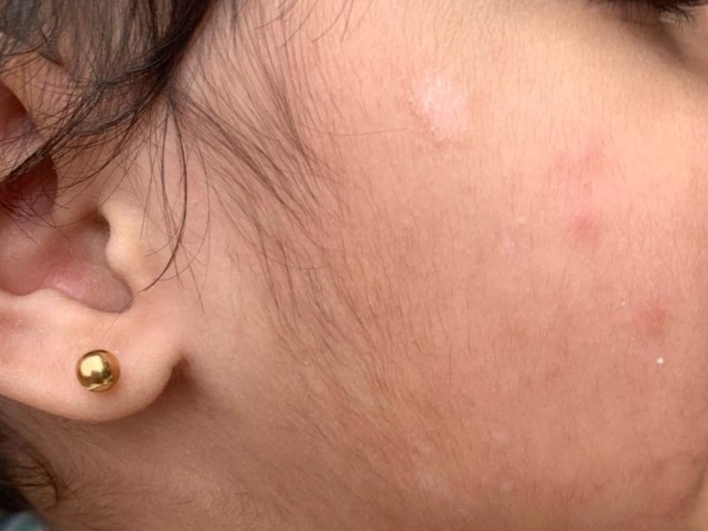 白斑癬(Pityriasis alba)
