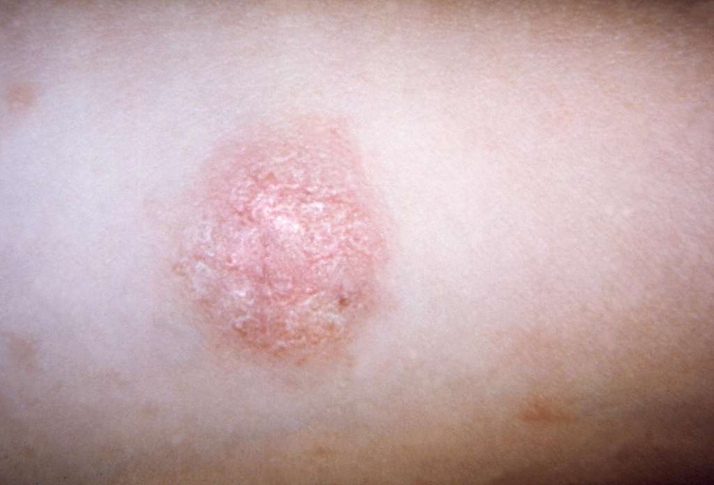 玫瑰糠疹(Pityriasis rosea)