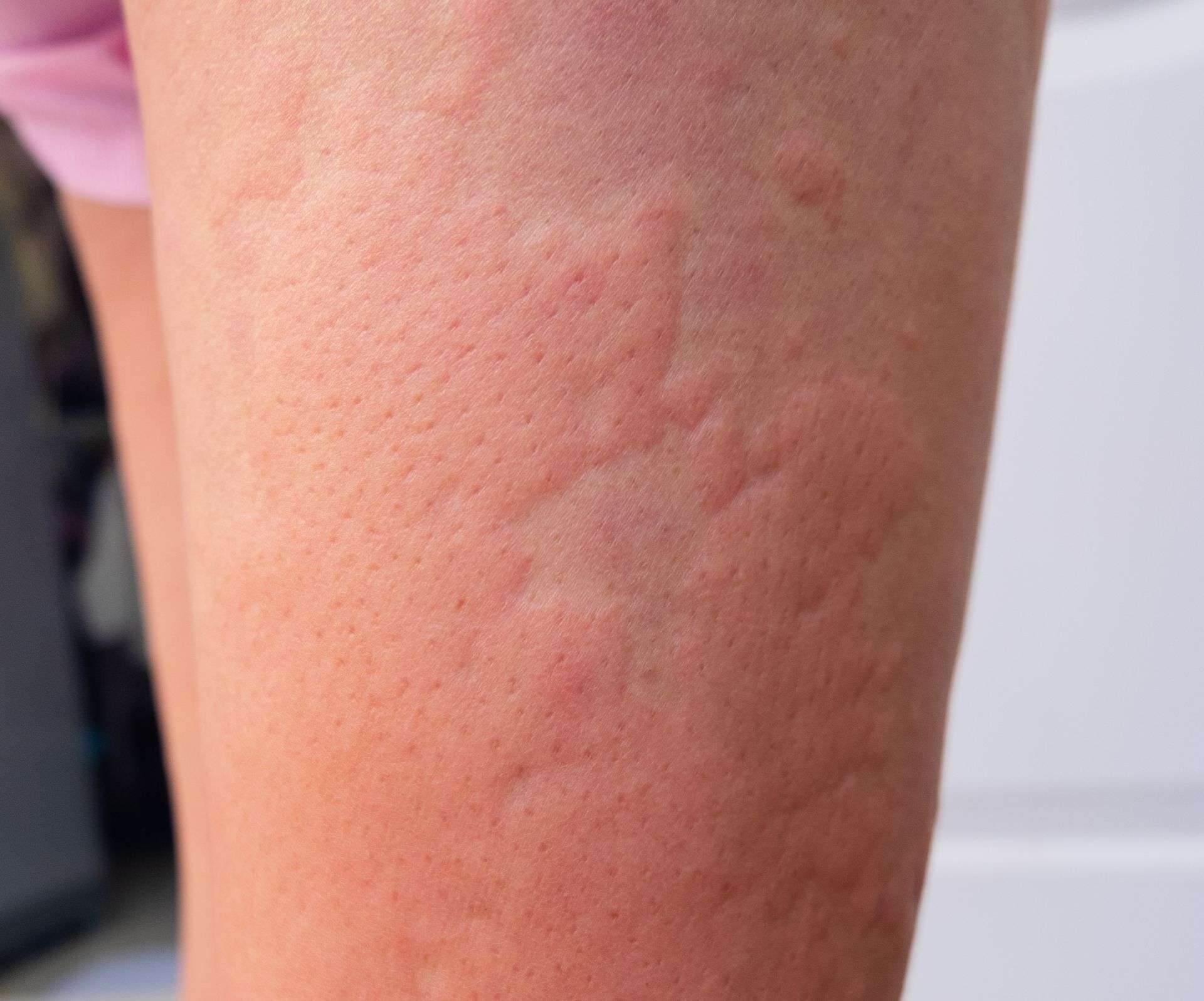 蕁麻疹 urticaria