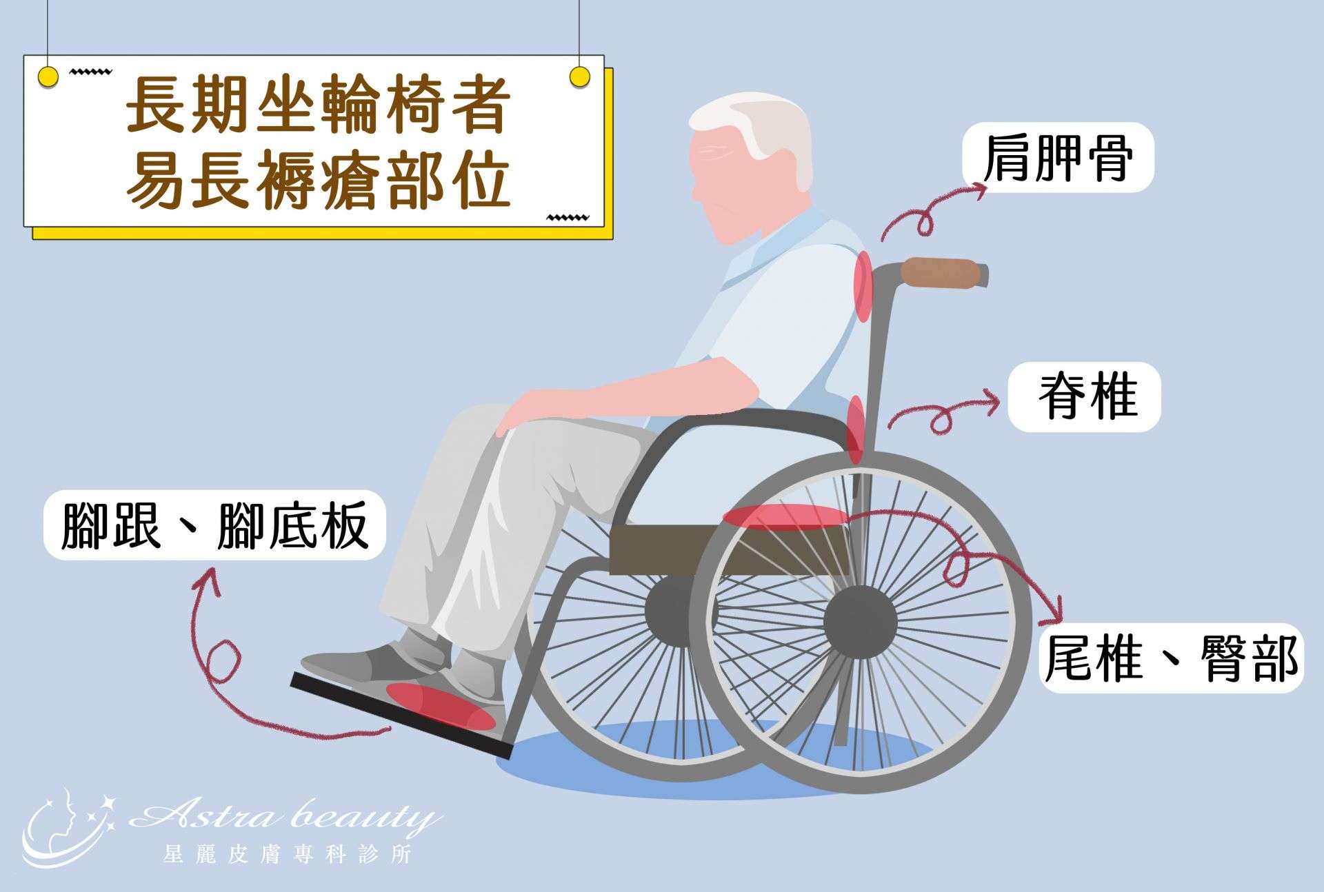 坐輪椅患者容易發生褥瘡