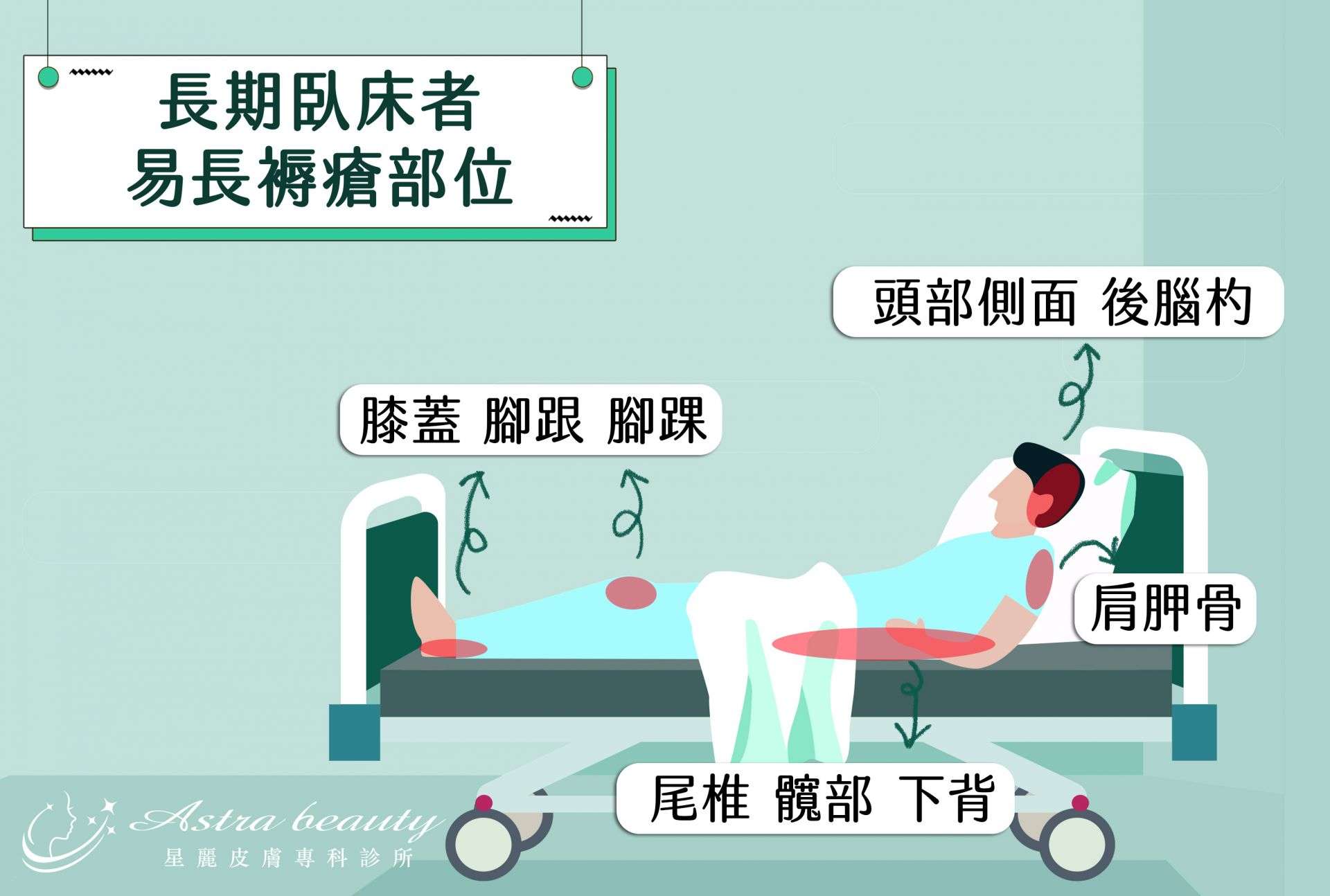 長期臥床者易長褥瘡部位