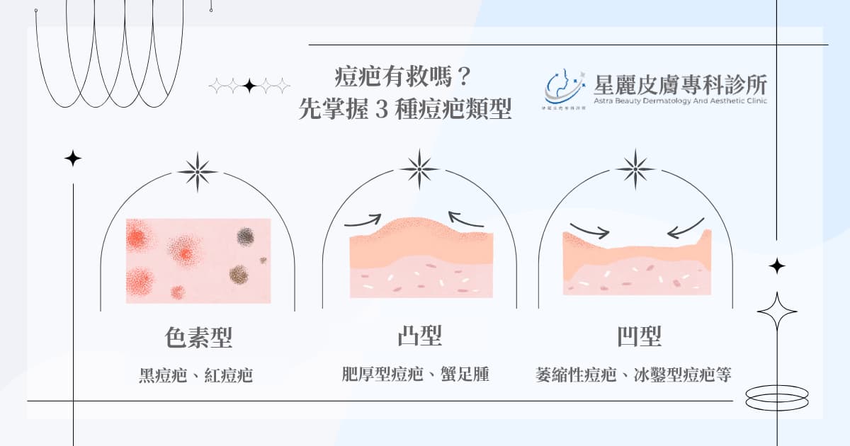 痘疤有救嗎?先掌握 3 種痘疤類型