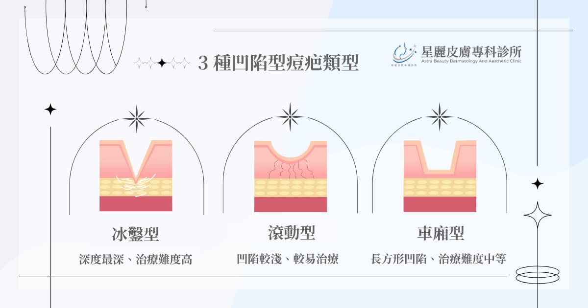 凹陷型痘疤